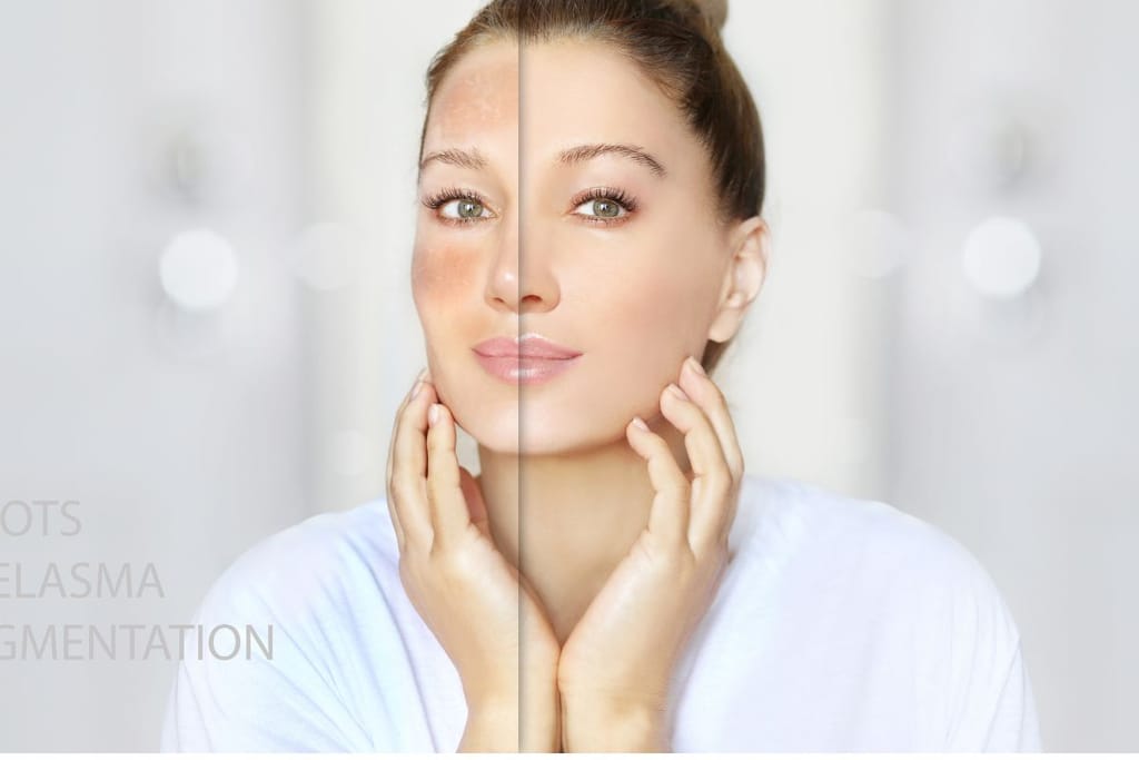 Naisen kasvot edestä kuvattuna, jaettu kahtia ennen–jälkeen-tyylisesti. Toisella puolella kasvoissa näkyy pigmenttimuutoksia, toisella iho on tasaisempi.