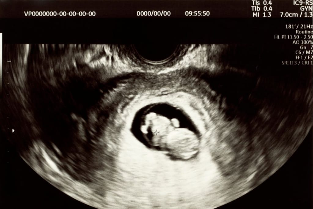 ultraäänikuva raskaus geneettinen kimeerismi syntymätön kaksonen dna