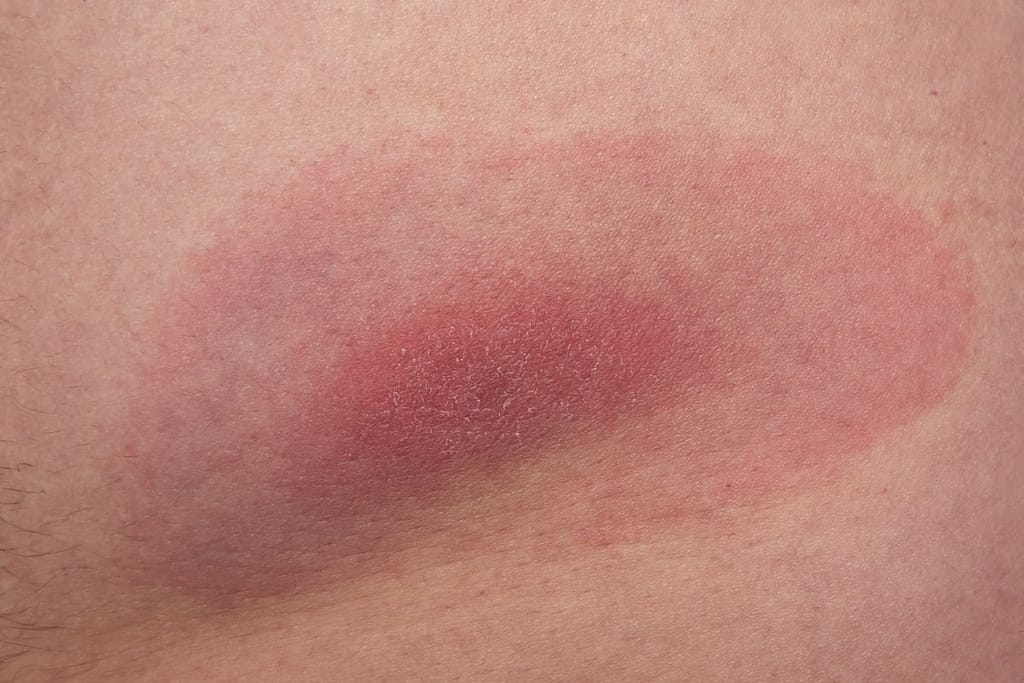 Laajeneva punoittava ihottuma punkin pureman jälkeen
