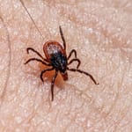 Punkki kiinnittyneenä ihoon lähikuvassa