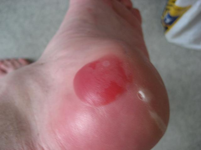 Lenkkeily on kivaa ilman sukkia.. =P Tais ilmeisesti vähän hiertää ? =D